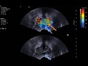 Aixplorer Prostate