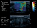 Aixplorer Thyroid